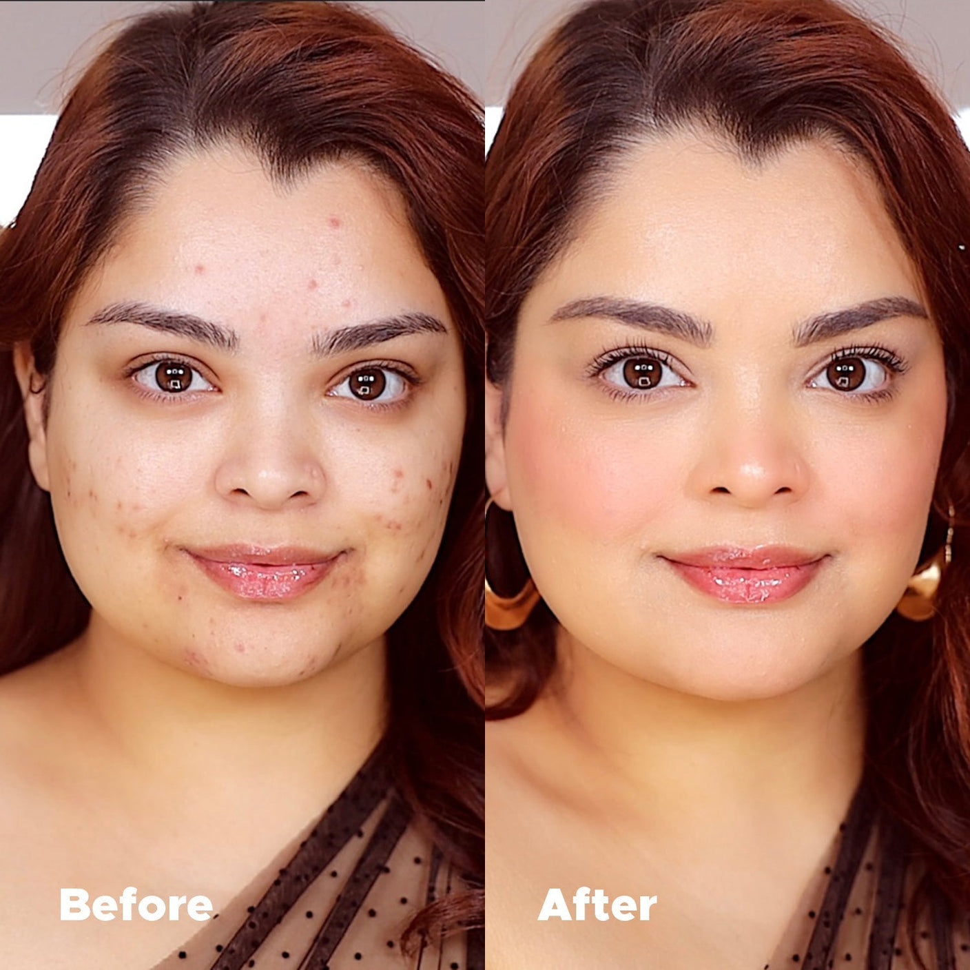 Universal Foundation before and after comparison showing seamless coverage of acne with a natural matte finish.